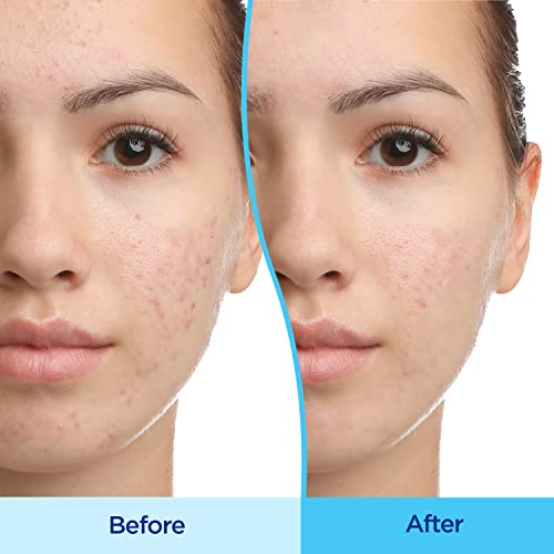 Differin Acne Treatment Gel, 30 Day Supply, Retinoid Treatment for Face DifferinBuy Supplements Australia