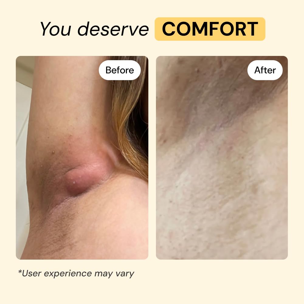 MyMagicHealer Universal Flare Care – Multi-Purpose Solution | Skin Flare-Ups - Hidradenitis Suppurativa, Folliculitis, Boils, Cysts