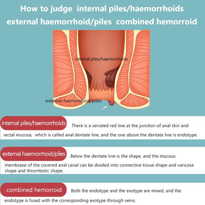 Hemorrhoid Cream for Men and Women, with Lidocaine and Phenylephrine HCl, Provides Fast Relief from hemorrhoid discomfort. Naturally formulated for Hemorrhoids and fissures (0.7 oz) AnisxBuy Supplements Australia