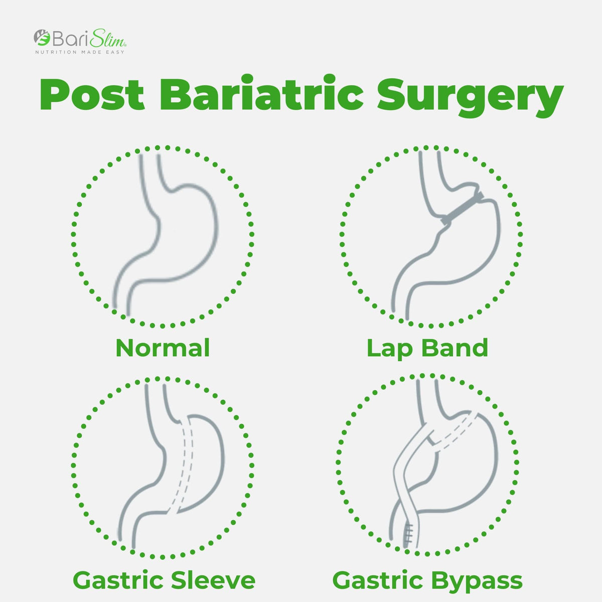 BariSlim Bariatric Calcium Citrate Plus Powder - Formulated for Patients After Weight Loss BariSlimBuy Supplements Australia