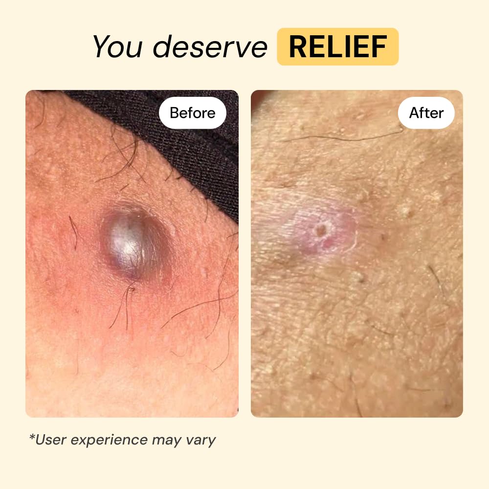 MyMagicHealer Universal Flare Care – Multi-Purpose Solution | Skin Flare-Ups - Hidradenitis Suppurativa, Folliculitis, Boils, Cysts