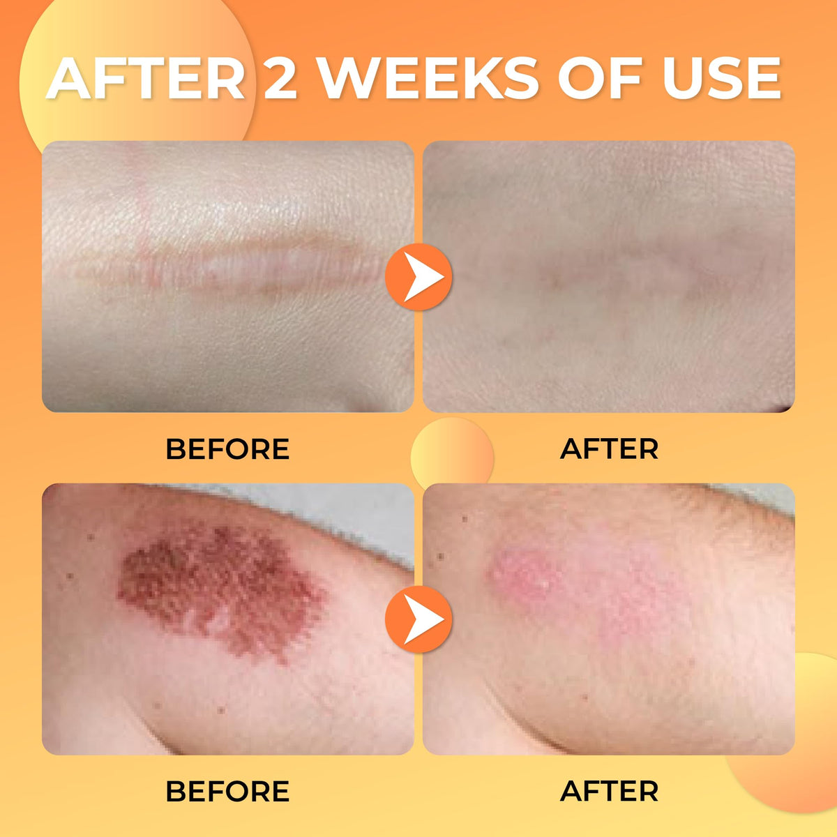 ABERA Scar Removal Cream for Women and Men - Rapid Repair of New Old Scars, Spots, Burns All Natural Treatment with Vitamin E, Alanine, Collagen (1 Box + 3 Eye Patch) ABERABuy Supplements Australia