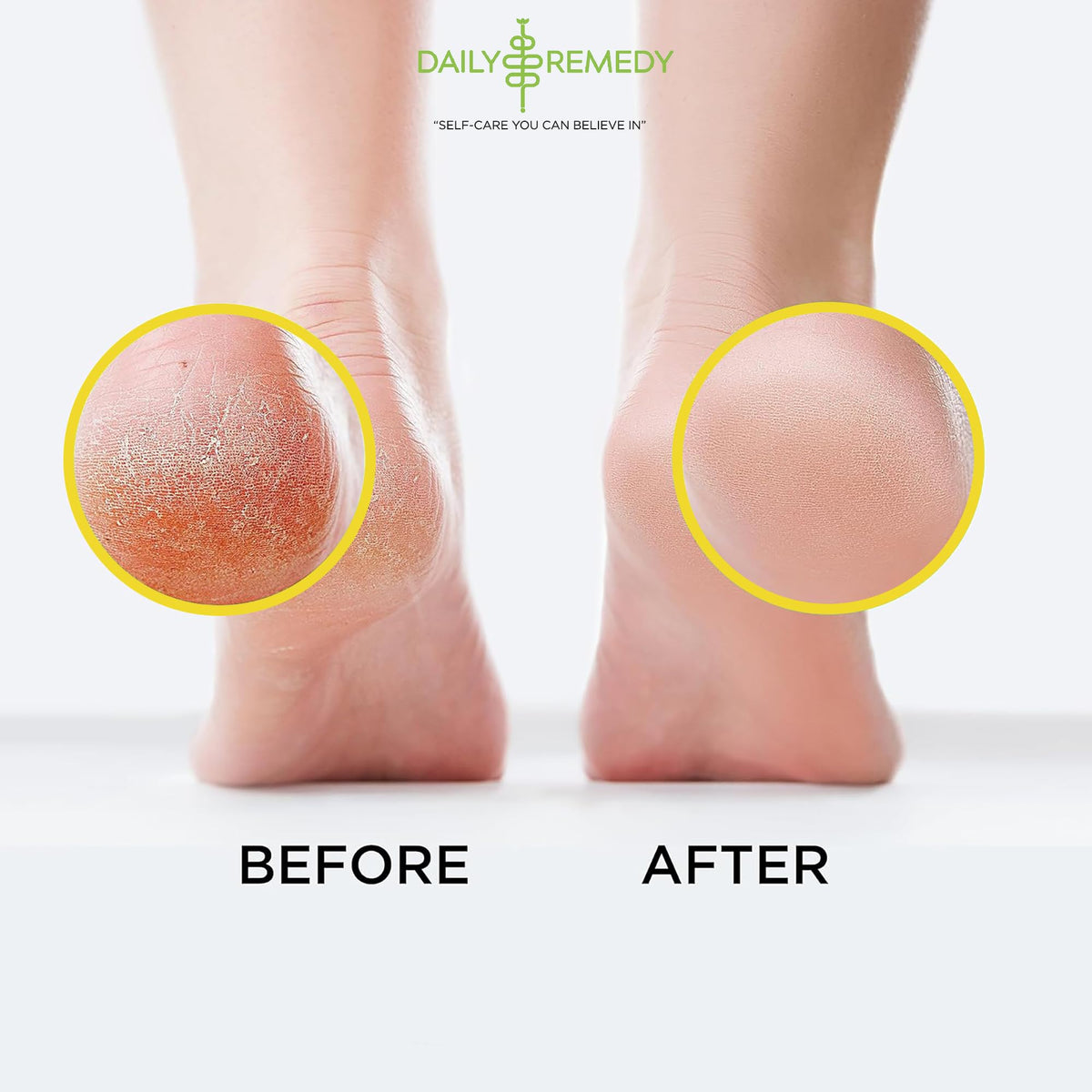 Citrus Detox Foot Soak with Epsom Salt - for Foot Callus, Immune Boost, Damaged Toenail DAILY REMEDYBuy Supplements Australia