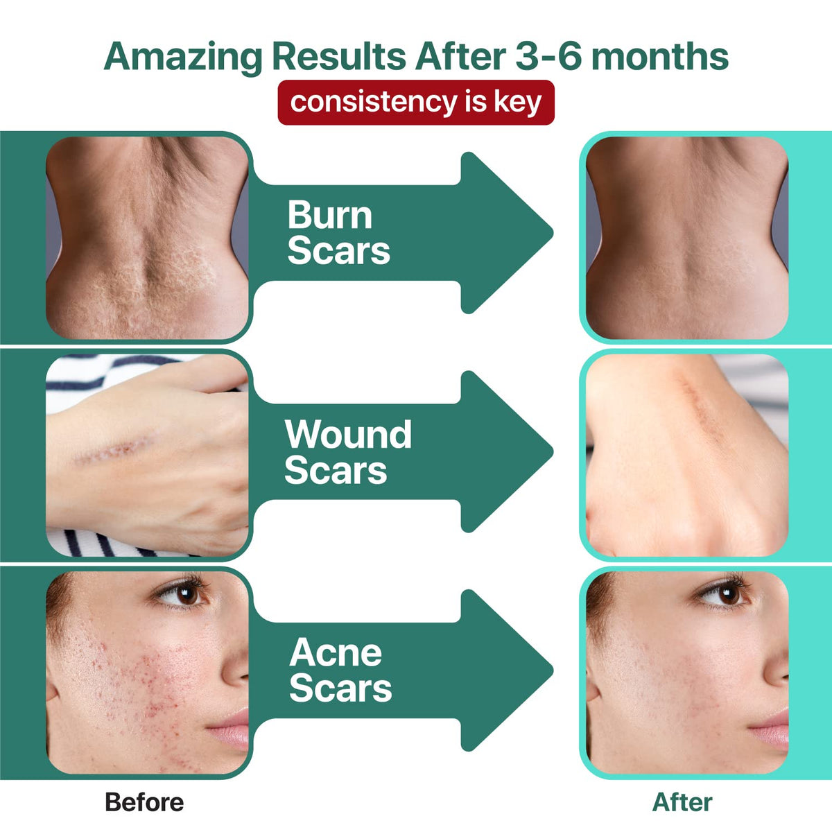 Ebanel Bundle of Lidocaine Numbing Cream, and Advanced Silicone Scar Gel 1 Oz Ebanel buy supplements Au