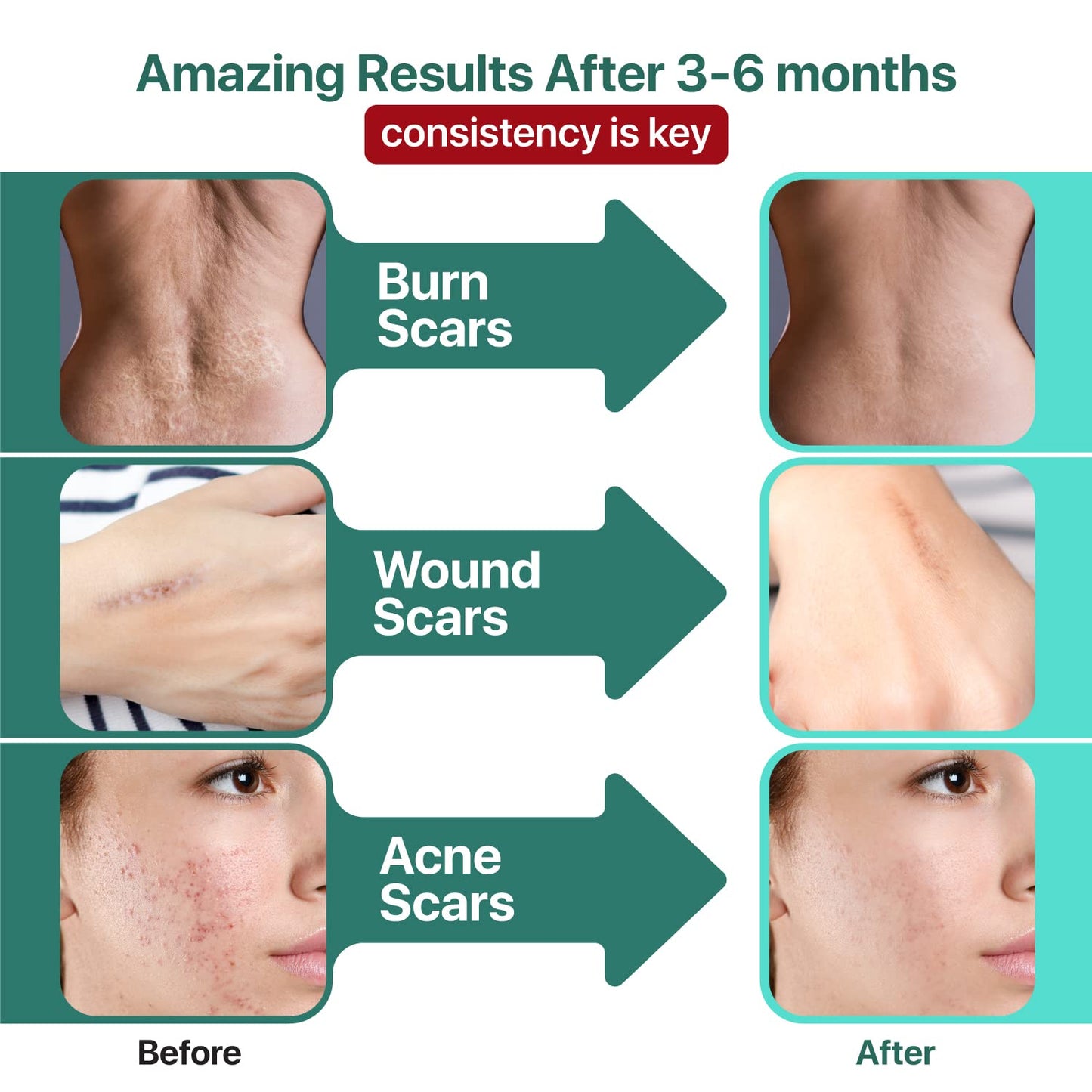 Ebanel Bundle of Advanced Silicone Scar Gel 1 Oz, and Hyaluronic Acid Serum Ebanel buy supplements Au