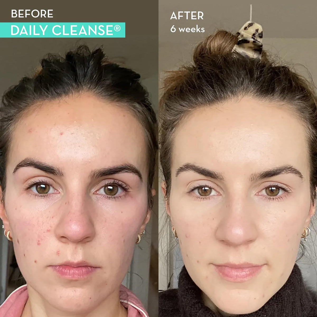 HUM Daily Cleanse Acne Supplements - Support for Clear Skin & Improved Digestion HUMBuy Supplements Australia