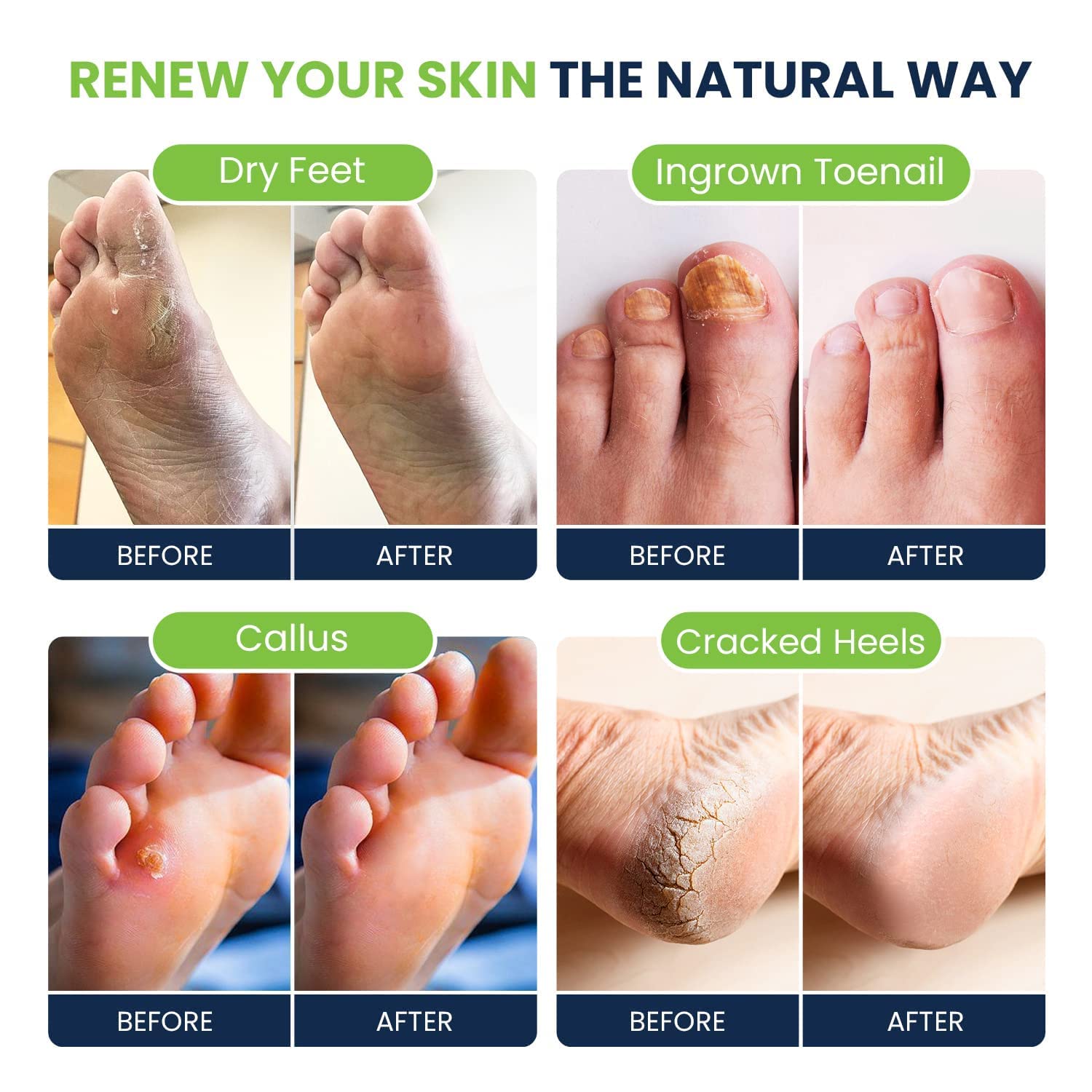 Tea Tree Oil Foot Soak with Epsom Salt - Best Toenail Fungus Treatment, Athletes FOOT CUREBuy Supplements Australia