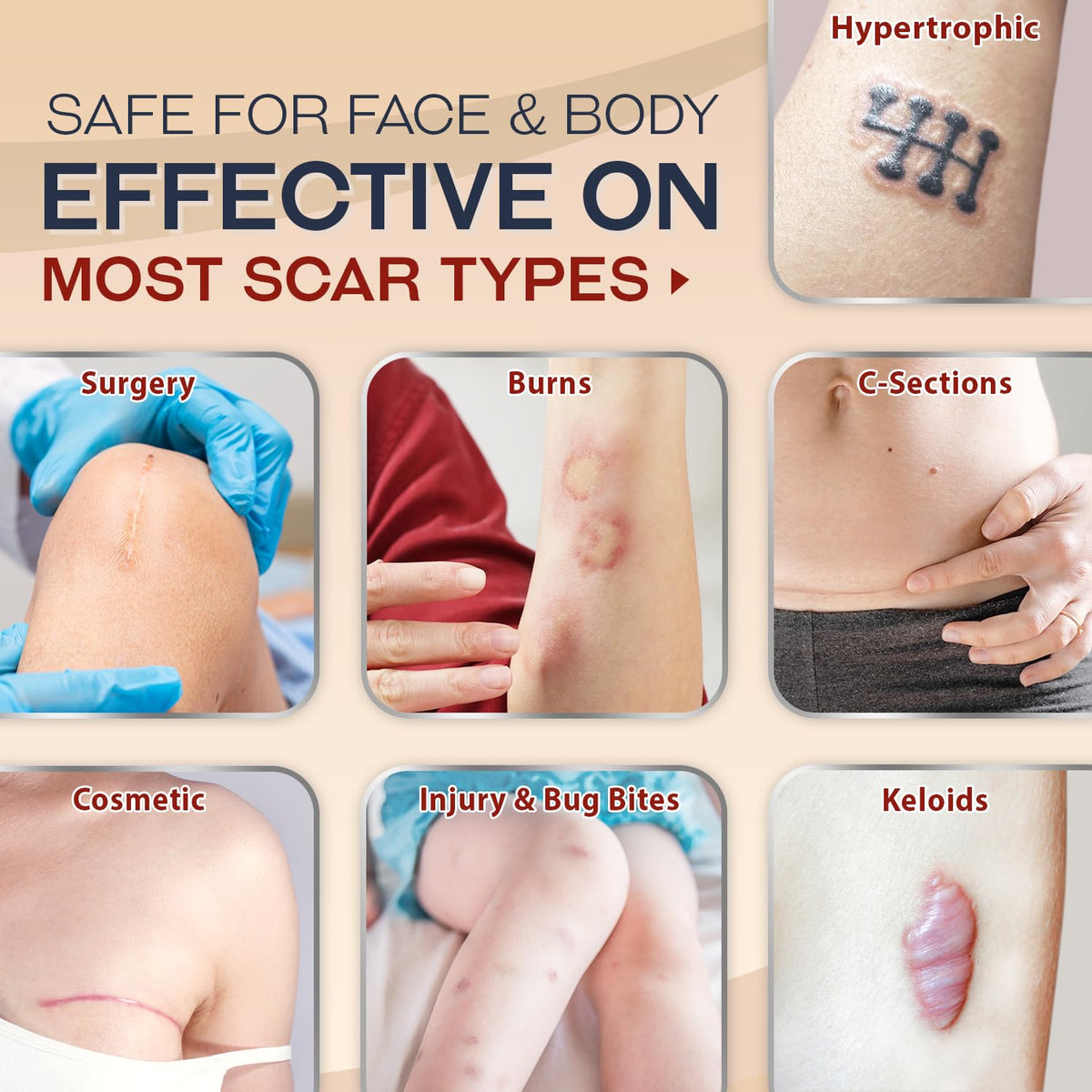 Ebanel Silicone Scar Gel with Allantoin, Emu Oil, Vitamin E and Onion Extract, For Old & New Scars from Surgeries, C-Section, Injuries, Burns & More Ebanel buy supplements Au