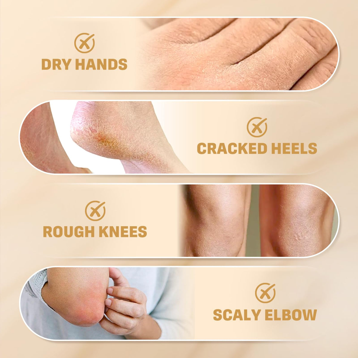 Clyecfra 60% Urea Cream with 2% Salicylic Acid, Urea Cream 60 Percent for Feet & Hands- Maximum Strength Moisturizer for Rough, Dry, Thick & Cracked Skin, Callus Remover, Deep Hydration, 150g Clyecfra buy supplements Au